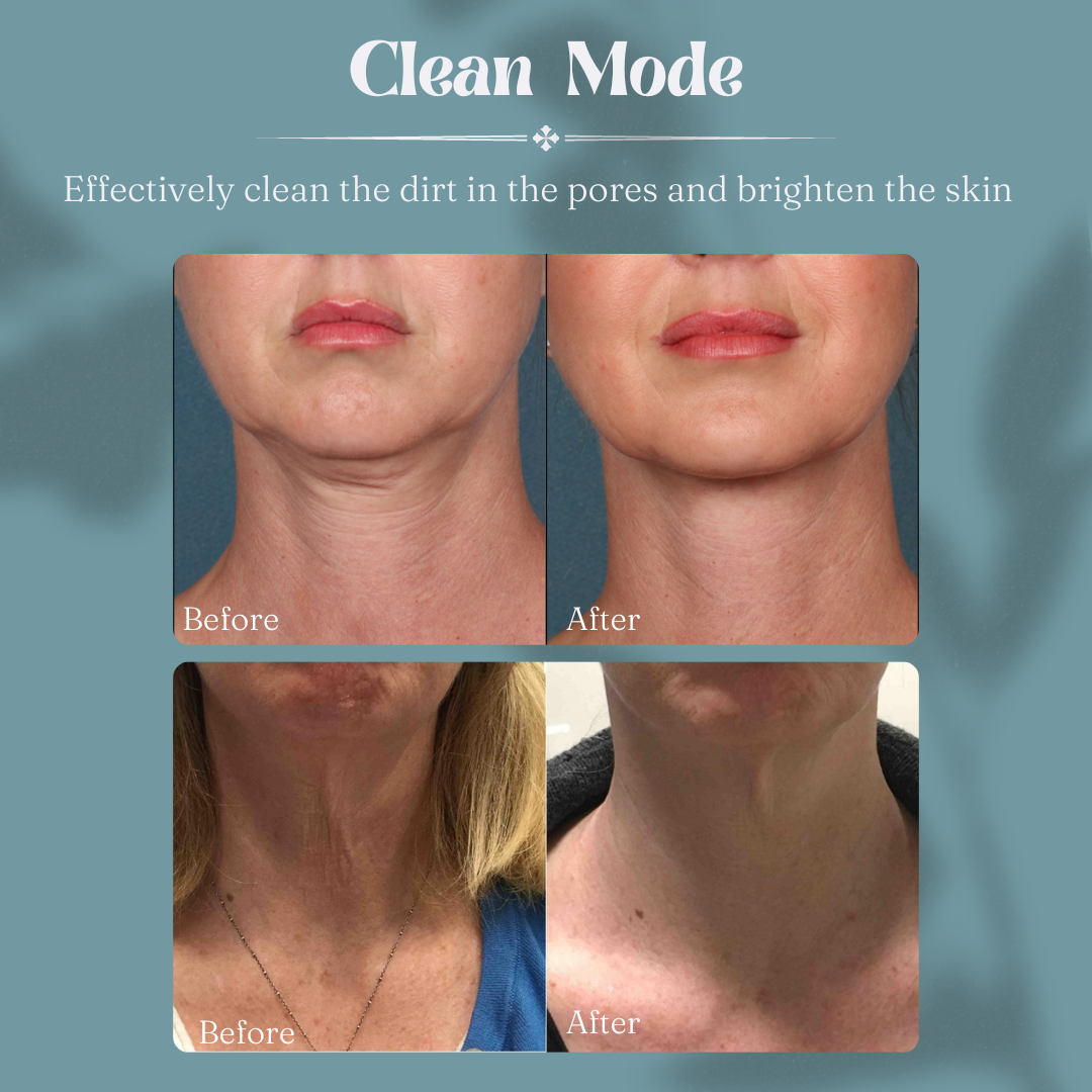 Neck Lift