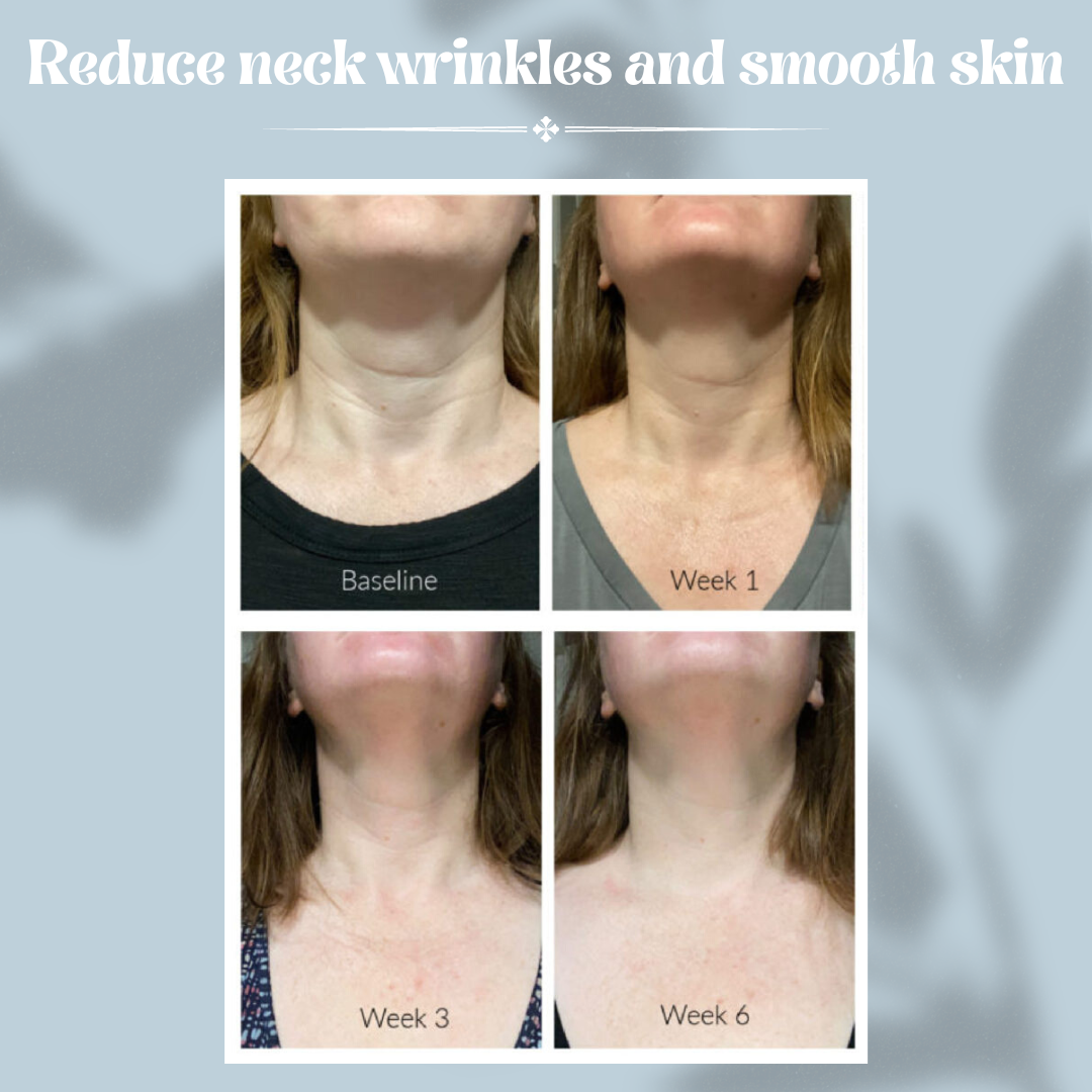 Neck Lift